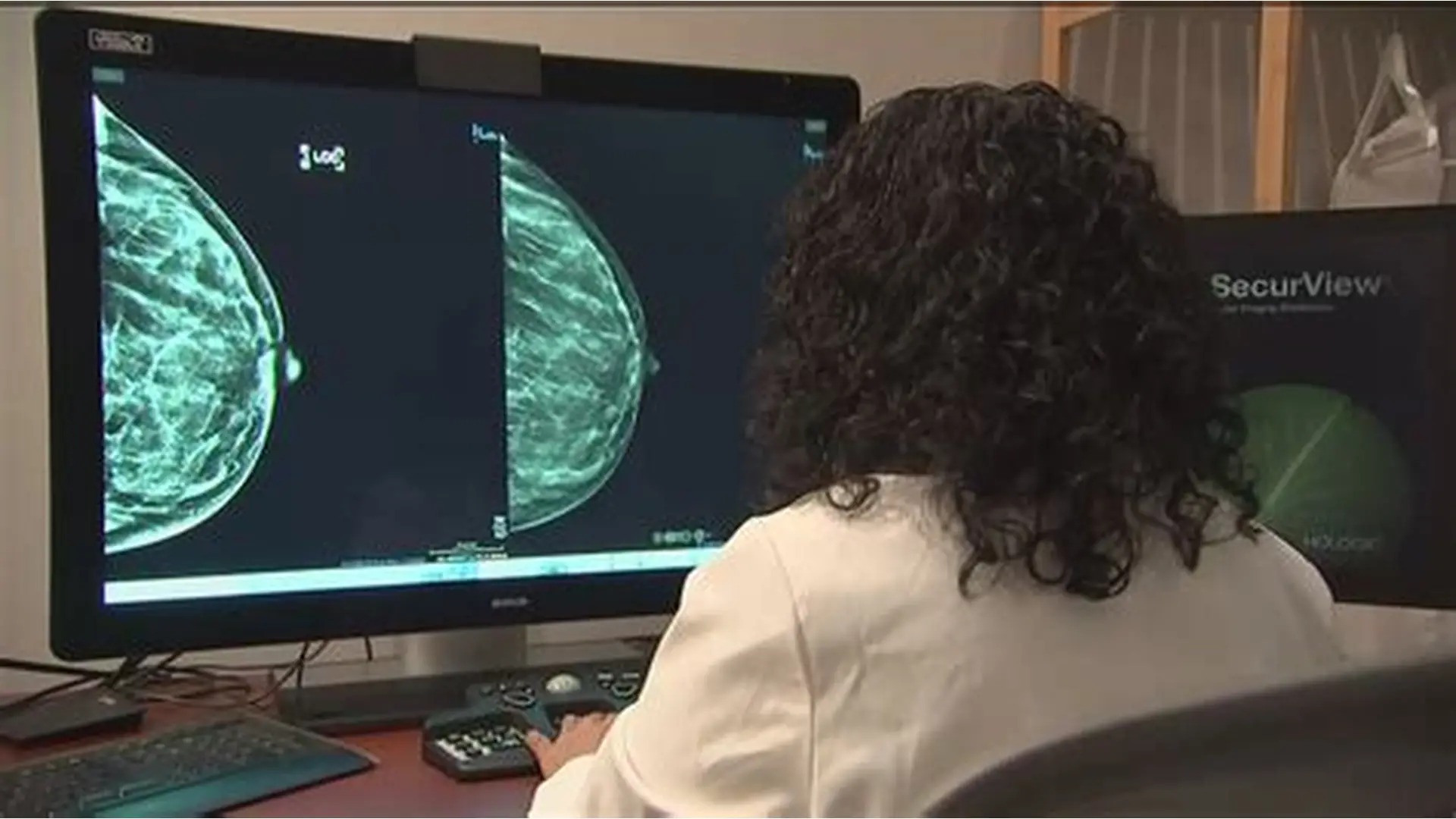 ماموگرافی در زنان جوان‌: راهنمای جدید چه می‌گوید؟