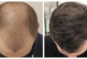 تغذیه پس از کاشت مو