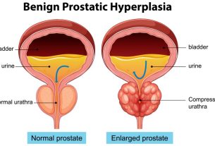 درمان واریکوسل