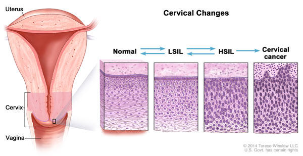 دهانه رحم و واکسن HPV