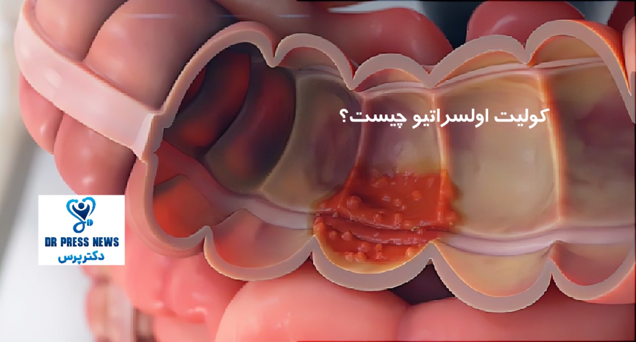 کولیت اولسراتیو