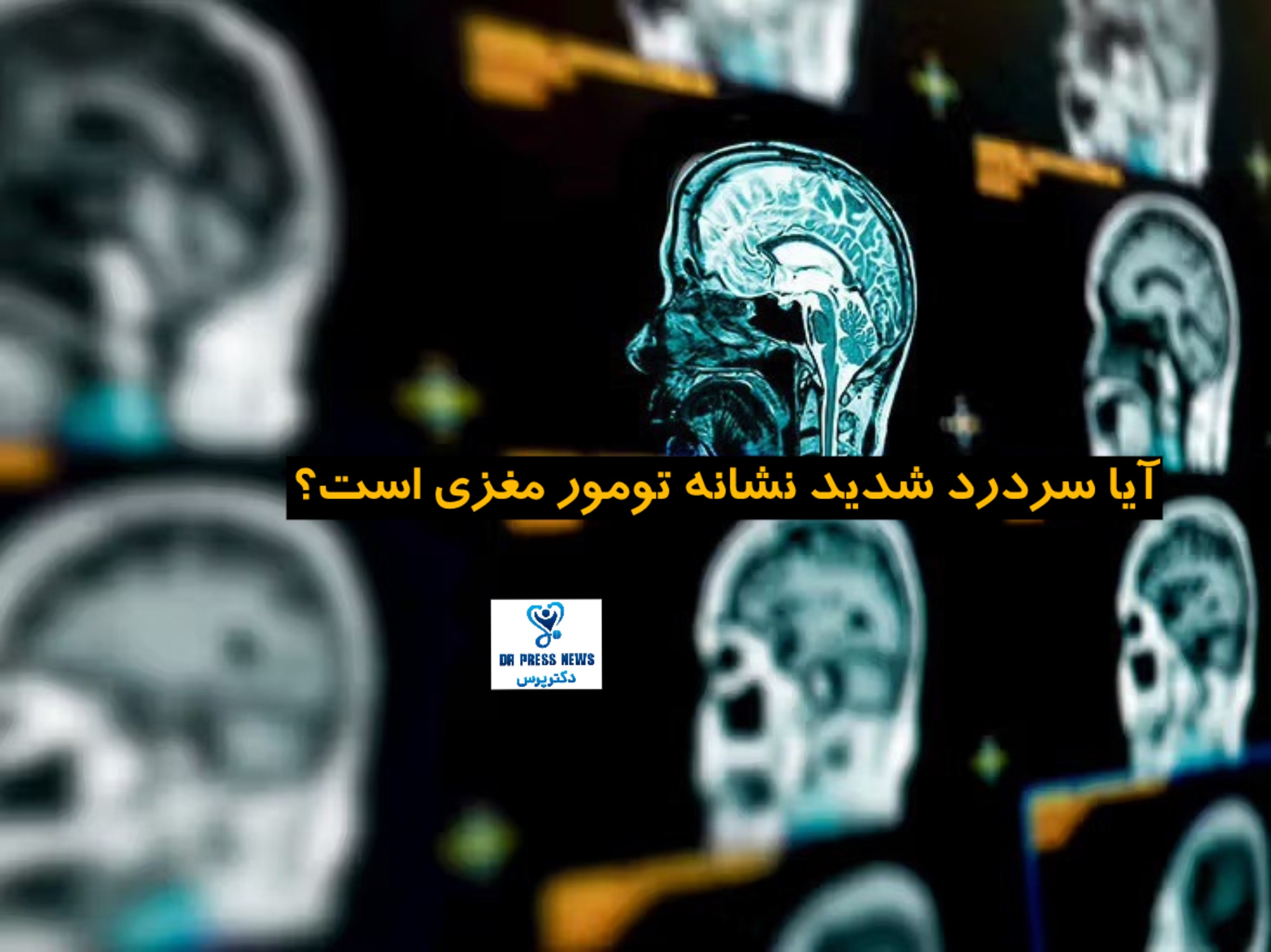 سردرد شدید و تومور مغزی