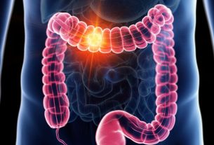 سرطان روده بزرگ