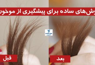 روش‌های ساده برای پیشگیری از موخوره + 8 علت موخوره