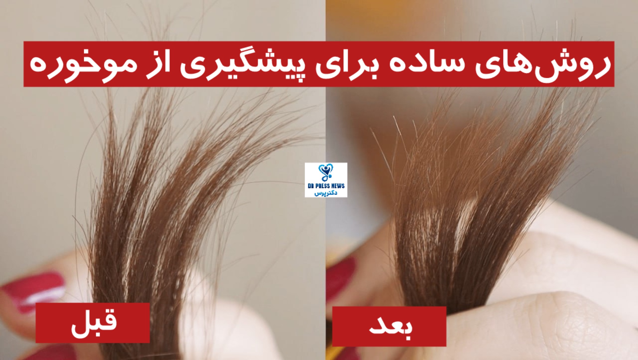 روش‌های ساده برای پیشگیری از موخوره + 8 علت موخوره