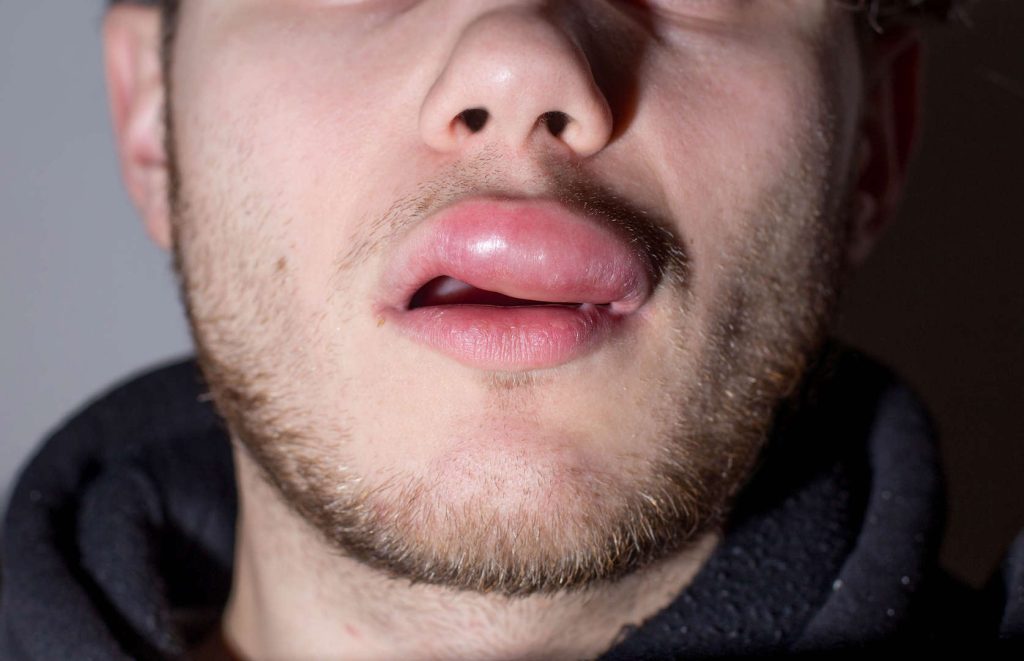 سندرم ملکرسون-روزنتال