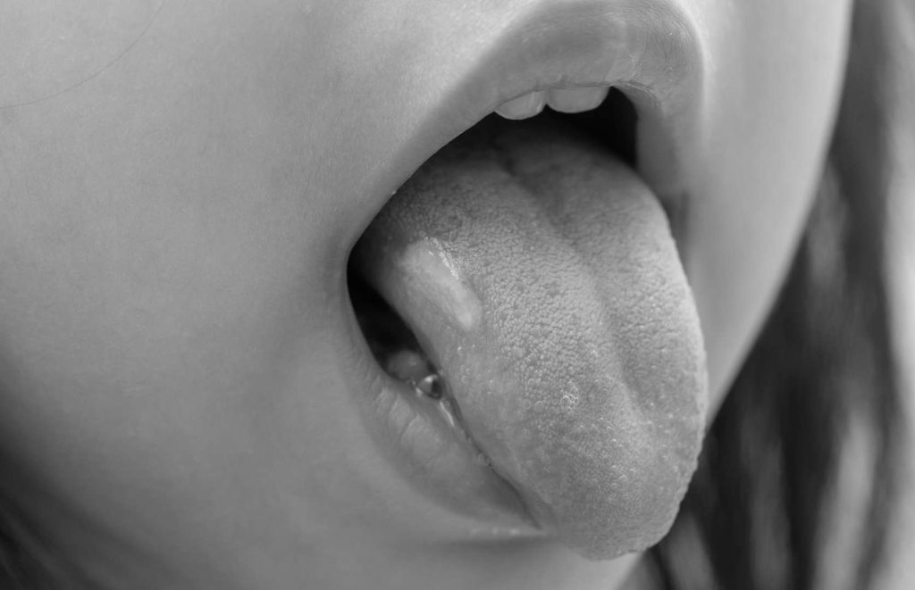 زخم‌های دهان