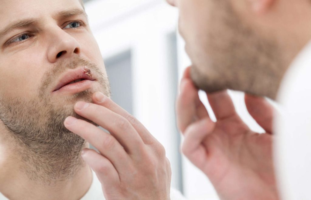 ویروس هرپس سیمپلکس