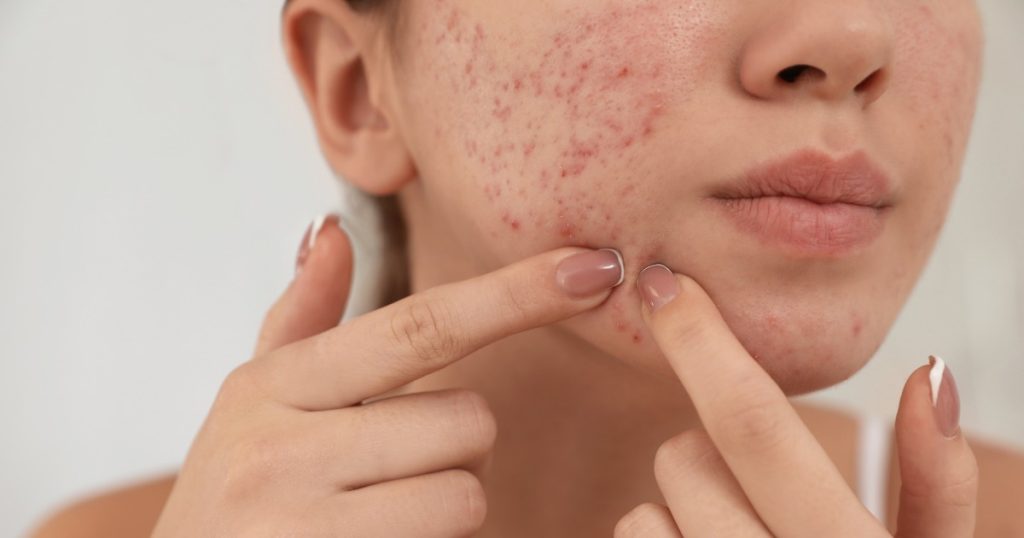 درمان‌های تکمیلی و غیر دارویی جوش صورت