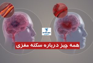 سکته مغزی