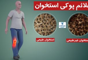 علائم پوکی استخوان