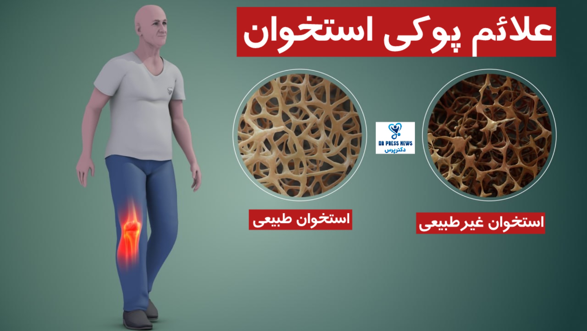 علائم پوکی استخوان