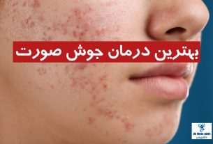 بهترین درمان جوش صورت