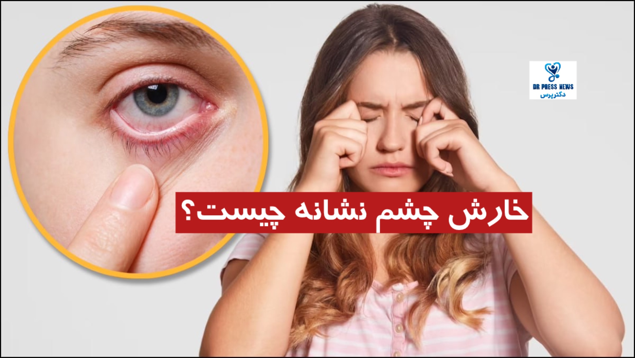 خارش چشم نشانه چیست