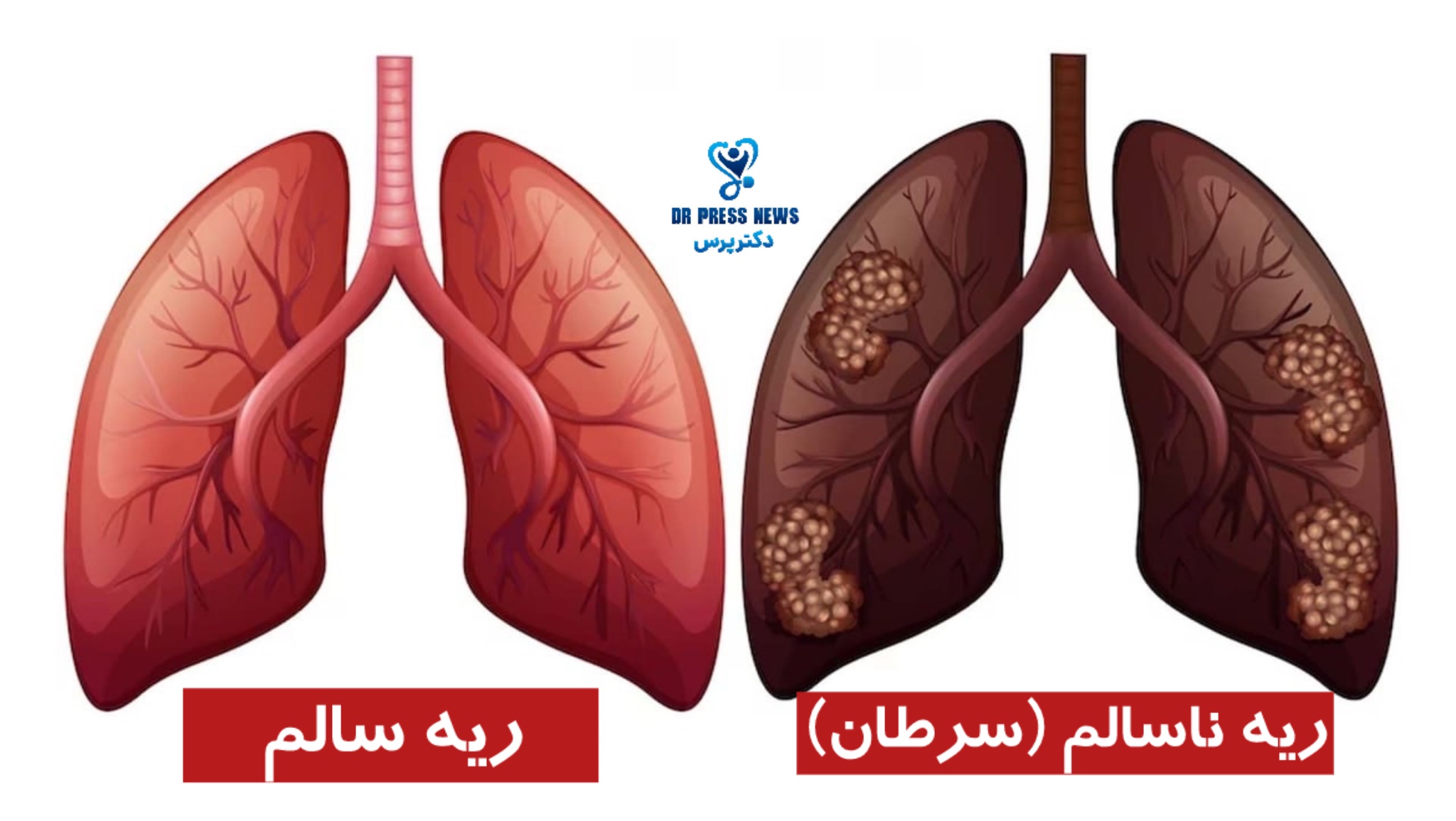 سرطان ریه چیست؟ علل، علائم، تشخیص و درمان