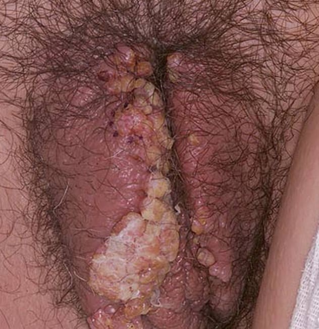 عکس زگیل تناسلی در زنان