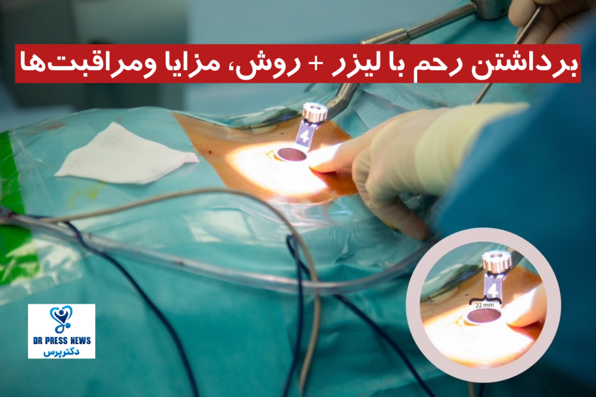 برداشتن رحم با لیزر + روش، مزایا و مراقبت‌ها