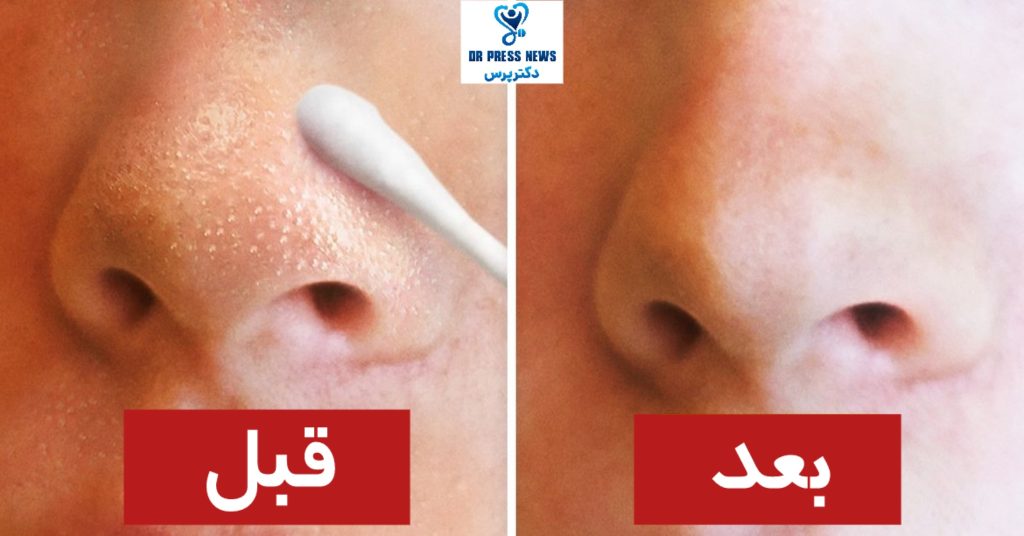 چگونه چربی بینی را درمان کنیم؟ (جدول جامع)