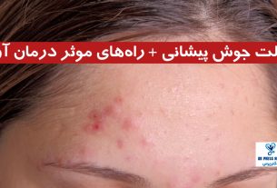 علت جوش پیشانی + راه‌های موثر درمان آن