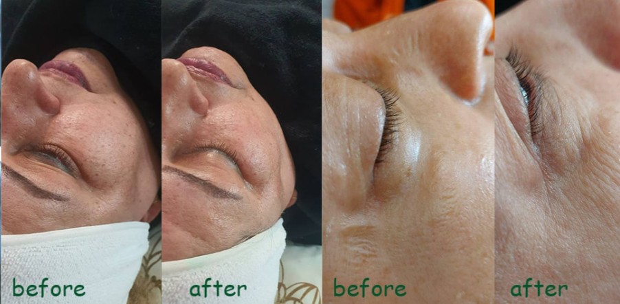 بهترین مرکز فیشیال صورت در جردن تهران