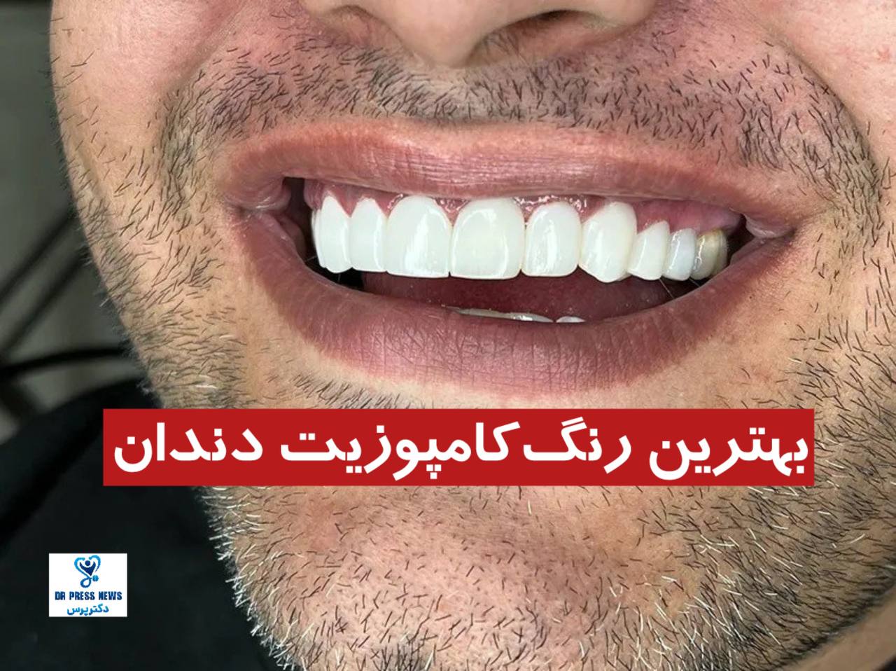 بهترین رنگ کامپوزیت دندان | بهترین مرکز کامپوزیت تهران