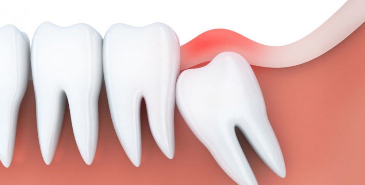 عصب‌کشی بهتر است یا کشیدن دندان عقل؟