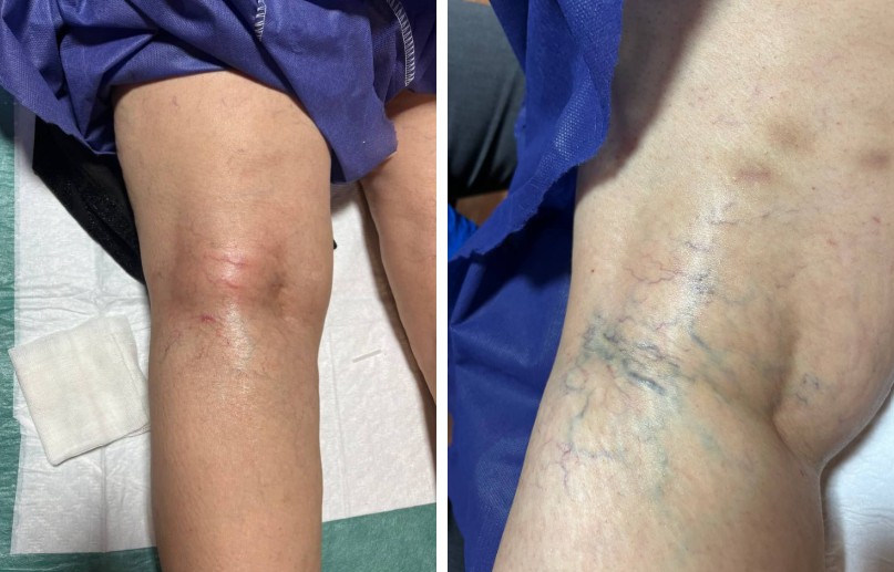 درمان تخصصی واریس؛ یکی از حوزه‌های برجسته فعالیت دکتر دودمان