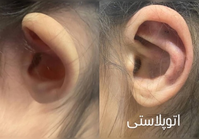 بهترین سن برای انجام جراحی اتوپلاستی