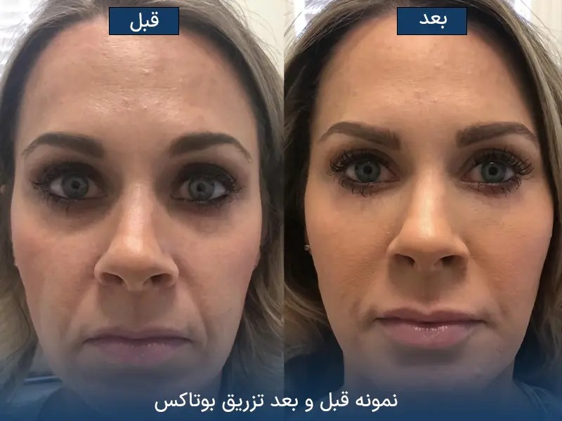 چه زمانی نتیجه نهایی بوتاکس مشخص میشود؟