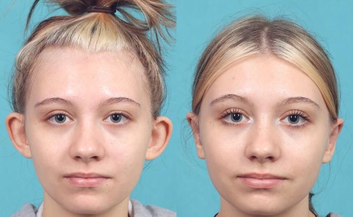 جراحی اتوپلاستی چیست؟ بهترین مطب جراحی زیبایی گوش در شیراز