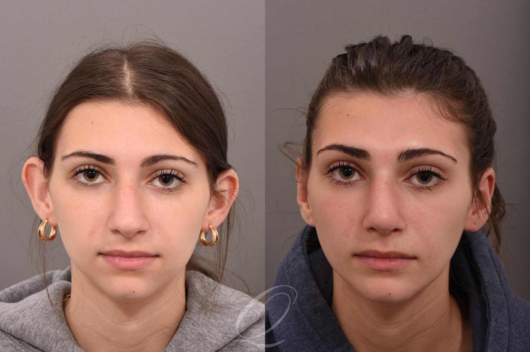 جراحی اتوپلاستی چیست؟ بهترین مطب جراحی زیبایی گوش در شیراز