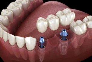 هزینه ایمپلنت دندان در تهران 1404 | قیمت‌ها، ضمانت و اقساط