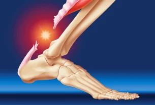 تورم پس از عمل تاندون آشیل (پاشنه پا) | بهترین روش درمان از نظر پزشک