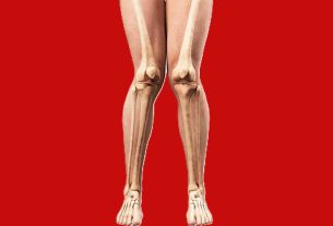 زانوی ضربدری چیست؟ علائم، علل و روش‌های درمان قطعی