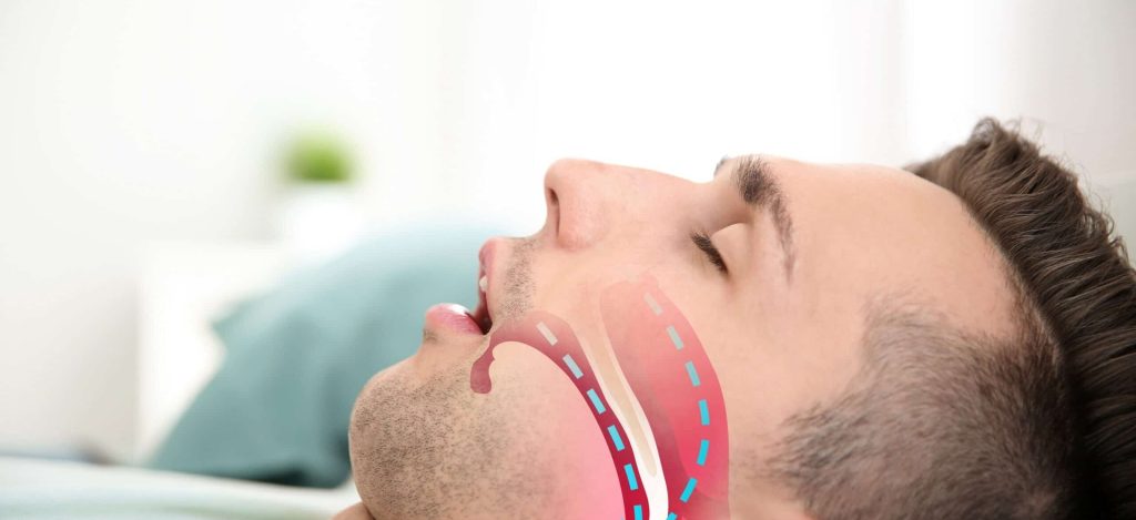 علت‌های اصلی بروز خروپف از نگاه دکتر رزم ‌پا