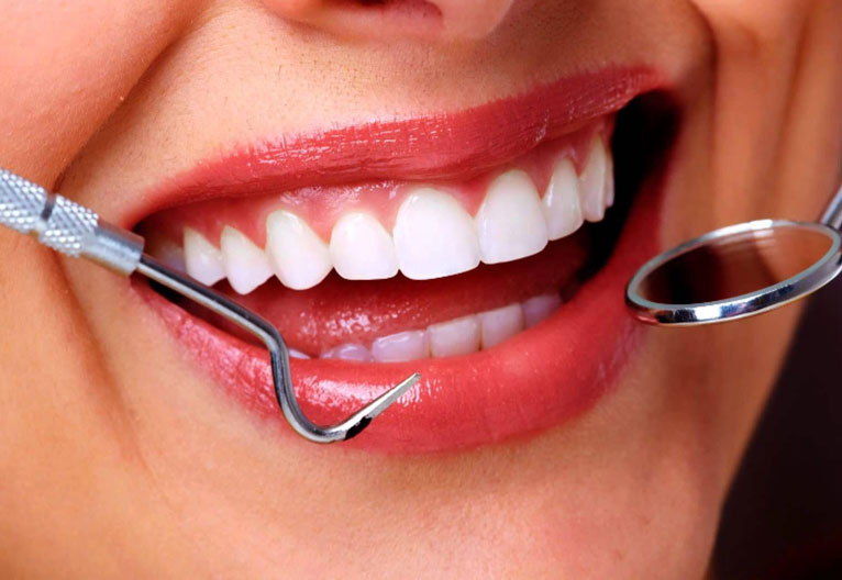 لمینت سرامیکی در تهران | راهنمای جامع برای لبخندی طبیعی و ماندگار