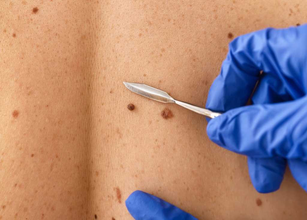 روشهای برداشتن خال