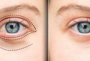 عمل کانتوپلاستی (چشم گربه‌ای) در تهران | مزایا، ماندگاری + هزینه