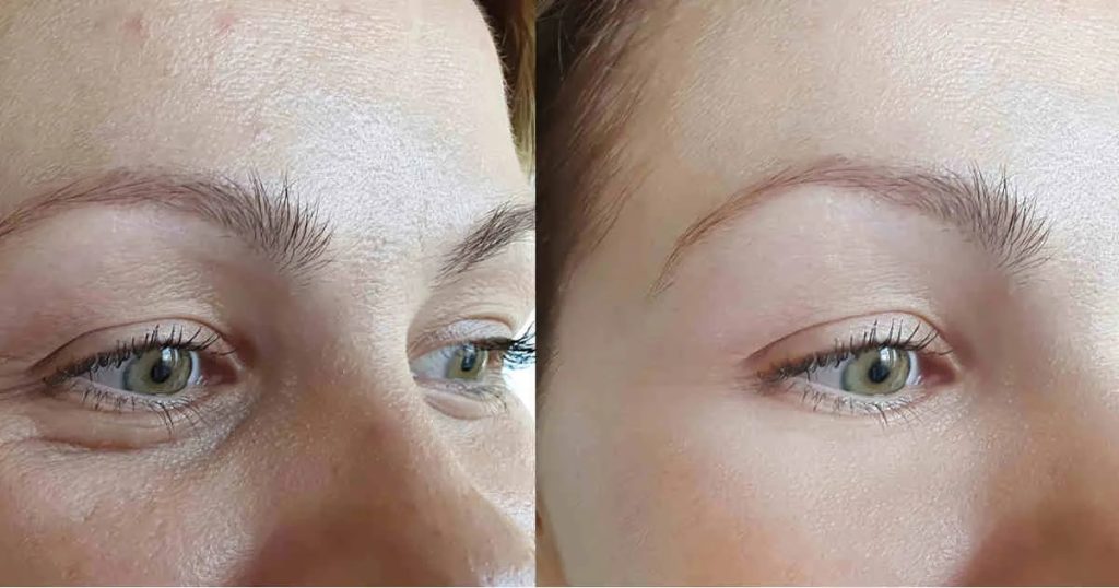 عمل کانتوپلاستی (چشم گربهای) در تهران | مزایا، ماندگاری + هزینه