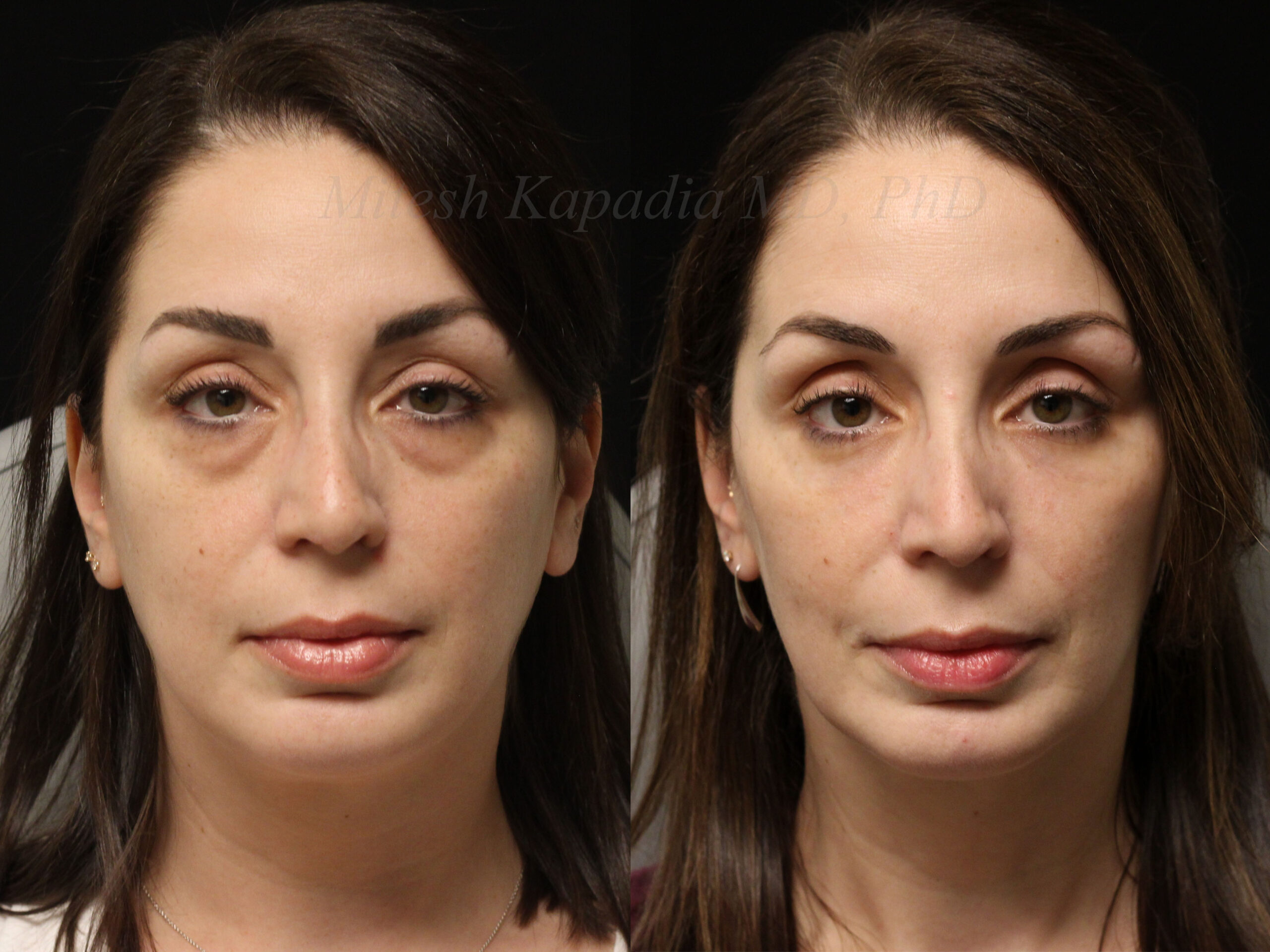 همه چیز درباره جراحی پلک بالا (بلفاروپلاستی فوقانی) + بهترین جراح در تهران