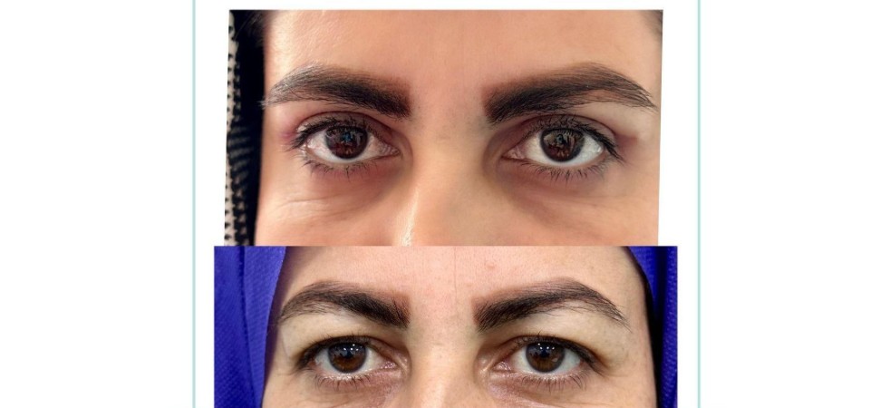 بلفاروپلاستی چشم (عوارض و مزایا از دیدگاه یک پزشک چشم‌ پزشکی)