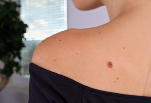 خال پوستی چیست؟ (انواع خال، علائم هشدار + روش‌های درمان)