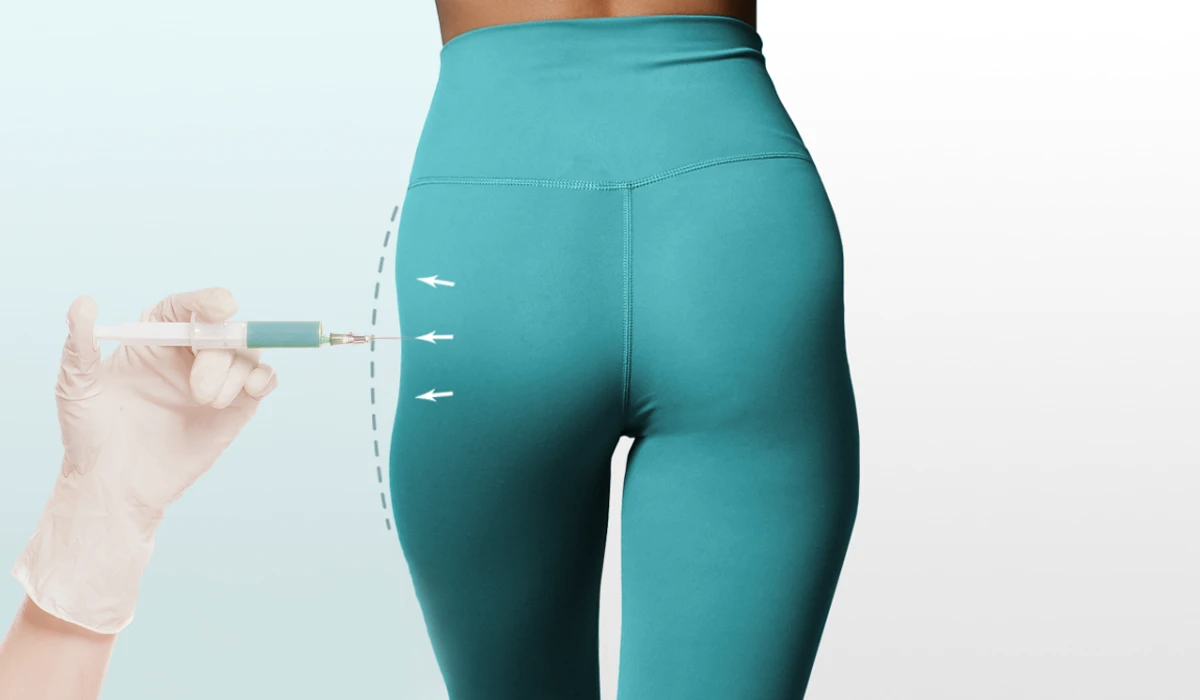 رفع گودی کنار باسن با تزریق چربی | درمان هیپ دیپس (Hip Dips) به روش انتقال چربی