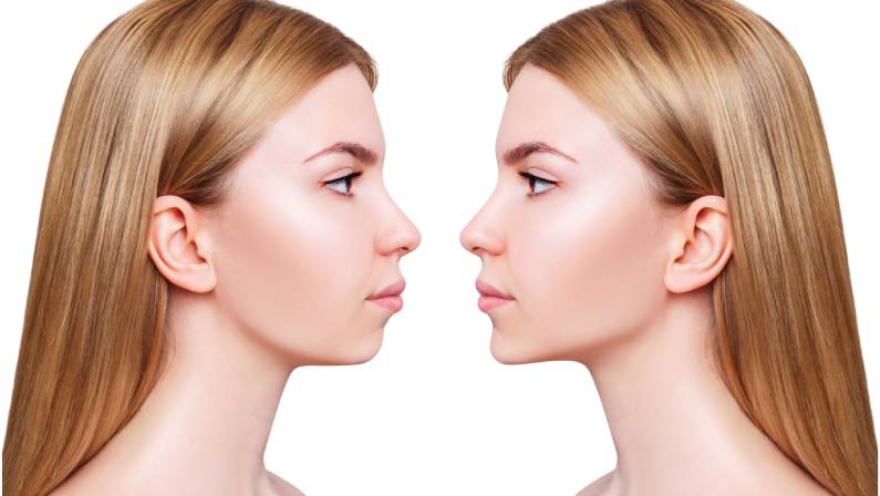 جراحی اصلاحی فک (ارتوگناتیک) |راهنمای جامع درمان ناهنجاری‌های فک و صورت