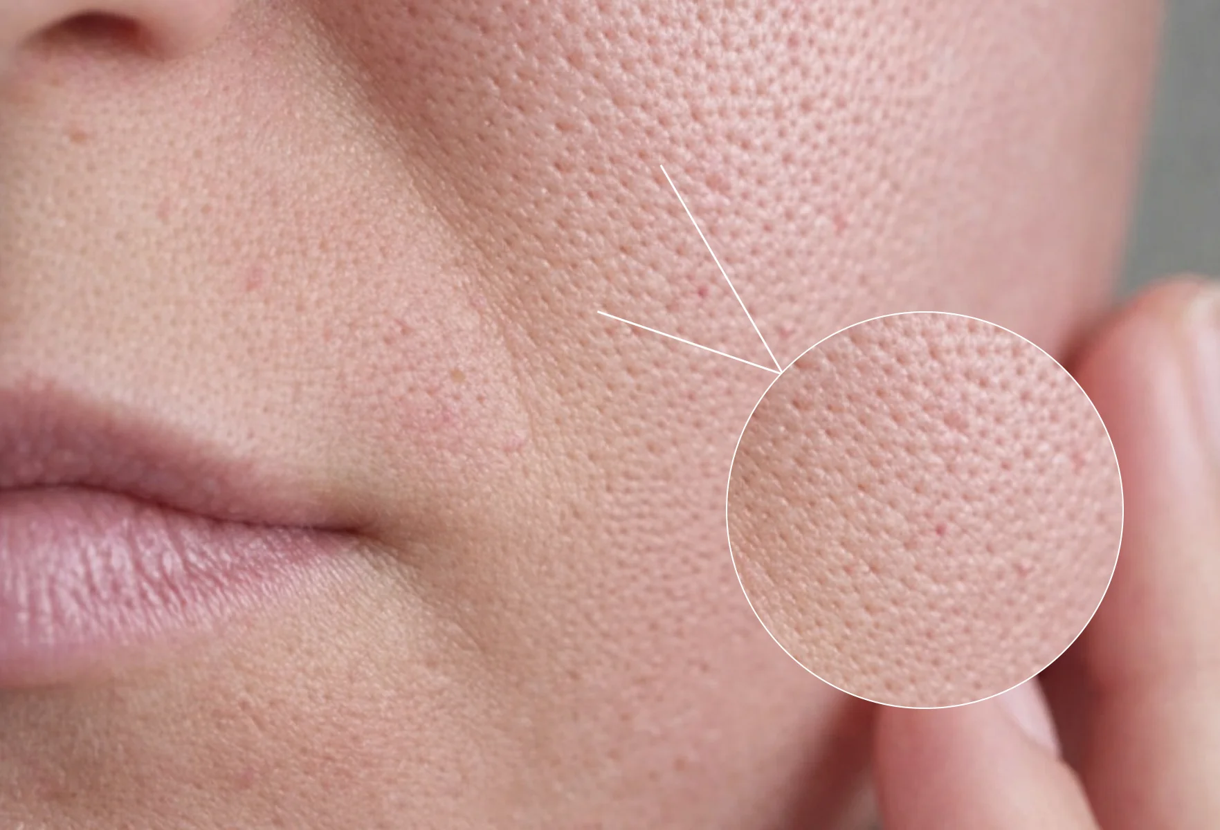 منافذ باز پوست چیست؟ | دلایل، روش‌های پیشگیری + درمان